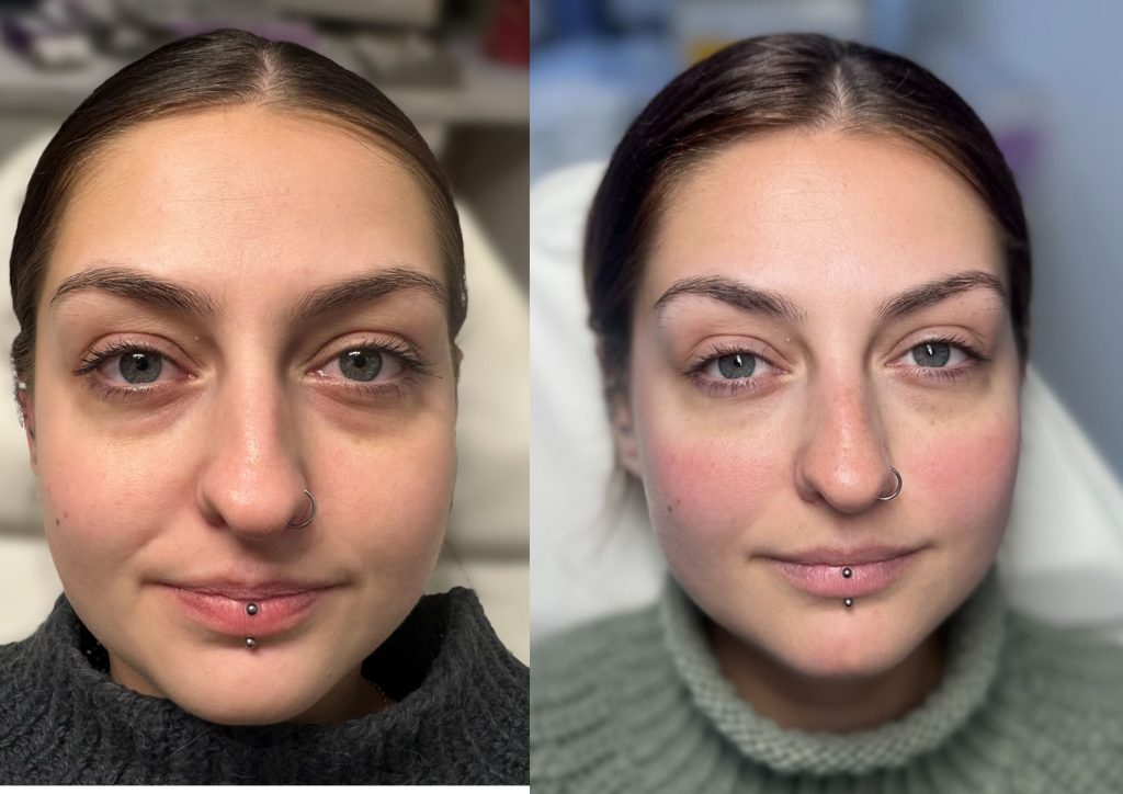 Before and after Skin Boosters at Lawrie aesthetics